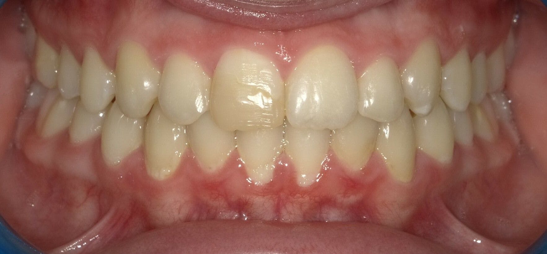 Transforming an open bite with tailored treatment