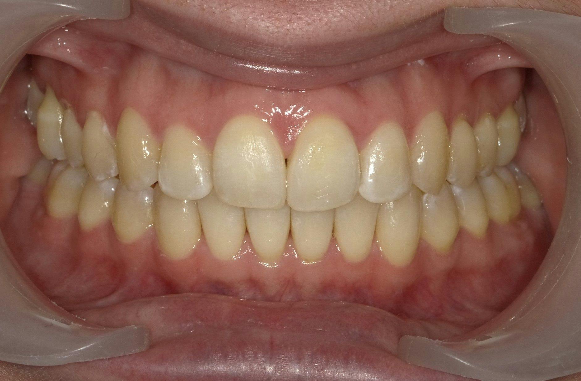 Unveiling a happier smile with Invisalign