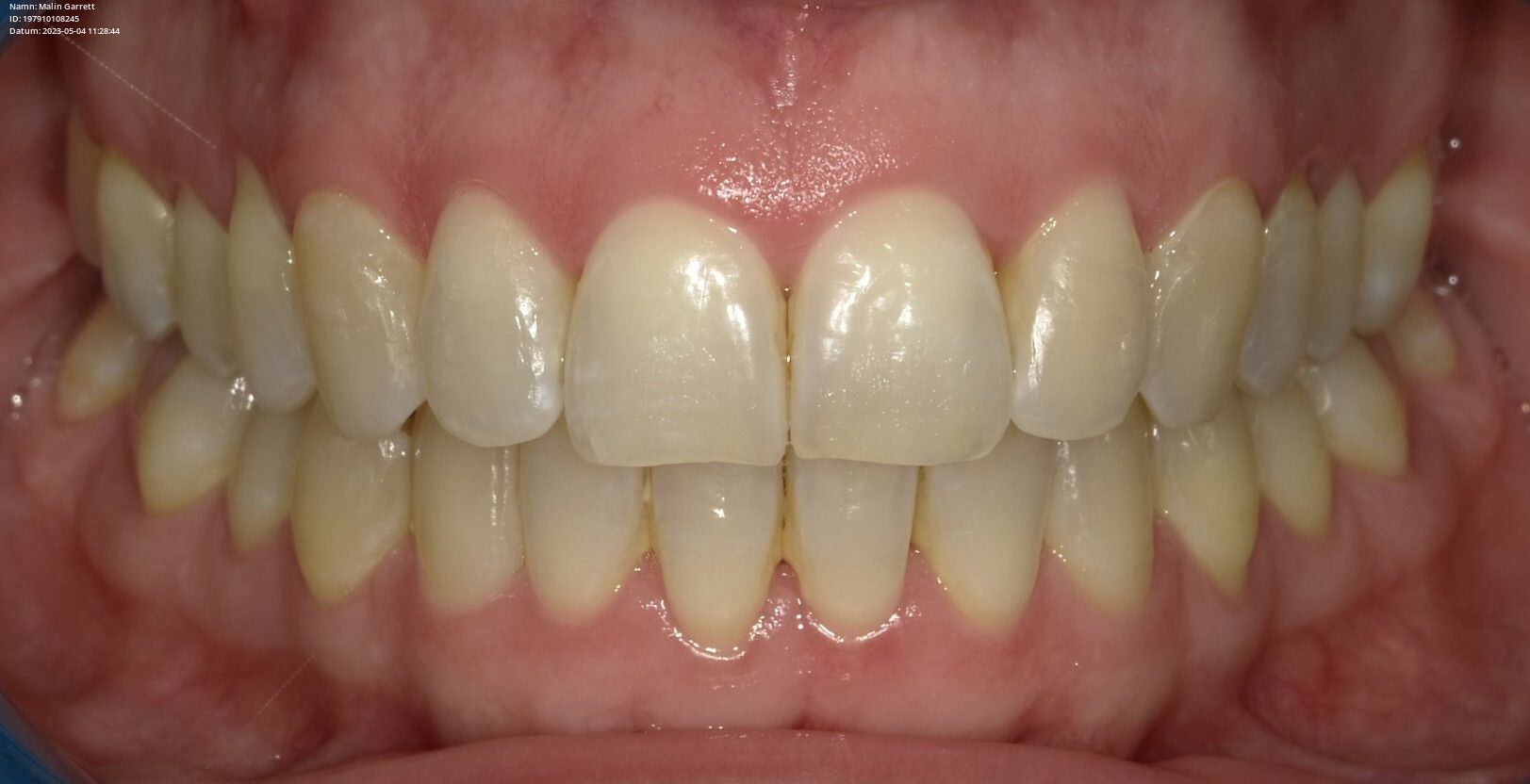 Achieving impeccable alignment without extractions
